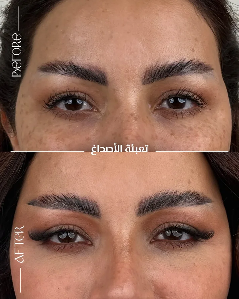 صورة مقارنة قبل وبعد للحالة رقم 04