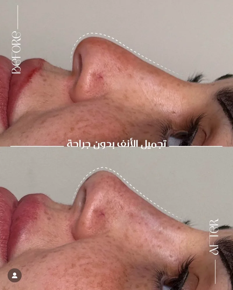 صورة مقارنة قبل وبعد للحالة رقم 09