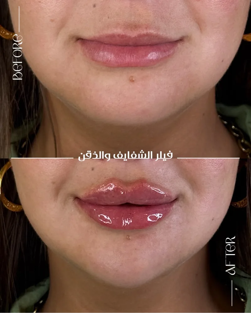 صورة مقارنة قبل وبعد للحالة رقم 11