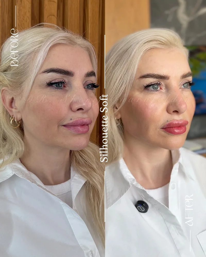 صورة مقارنة قبل وبعد للحالة رقم 14